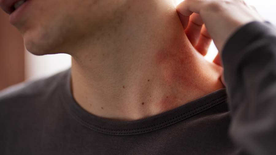 Coceira e manchas após exercício ou banho quente podem indicar urticária colinérgica