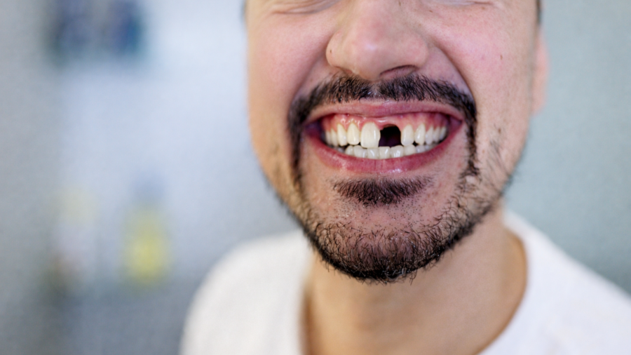 Quando falta um dente: impactos silenciosos que vão além do sorriso